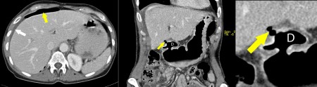 Perforated Duodenal Ulcer – CT