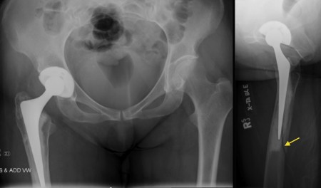 Periprosthetic femur fracture