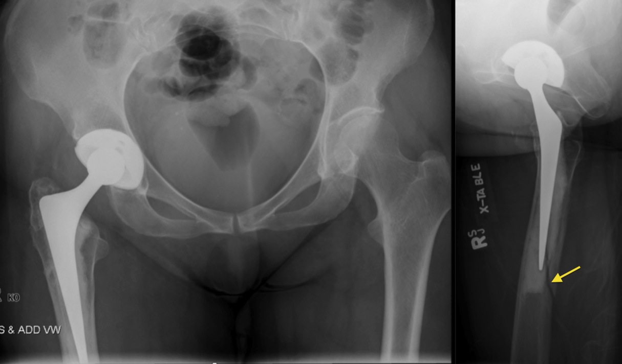 Periprosthetic femur fracture - Radiology at St. Vincent's University