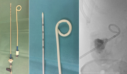 Pigtail drainage catheters. These contain a metal stiffener and are inserted over a guide wire. Note the multiple side holes in the end of the catheter on the left. The thin black thread, when pulled, gives the catheter its pigtail shape. The image on the right, taken during an abscess drainage, shows what these look like on fluoroscopy.