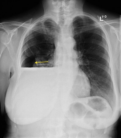 Hydropneumothorax