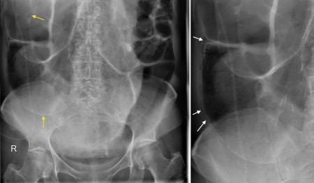 Pneumatosis intestinalis