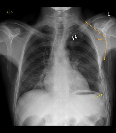 Tension pneumothorax due to rib fracture