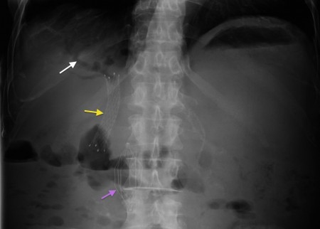 Pneumobilia – radiograph