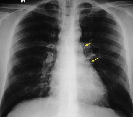 Pneumomediastinum