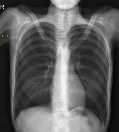 Pneumoperitoneum – erect CXR