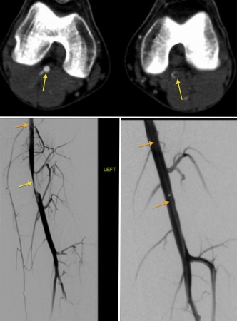 Popliteal entrapment syndrome – thrombolysis