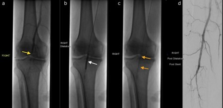 Popliteal angioplasty – atherosclerosis