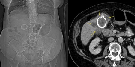 Porcelain gallbladder with carcinoma