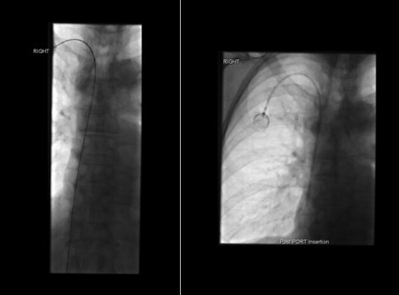 Portacath insertion