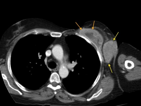 Radiation-induced sarcoma