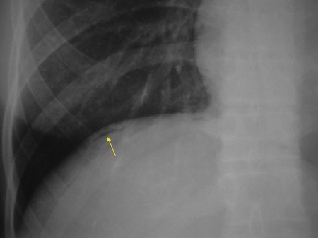 Pneumoperitoneum – erect CXR (2)