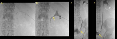 Ureteric stent insertion