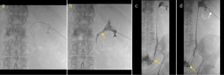 Ureteric stent insertion