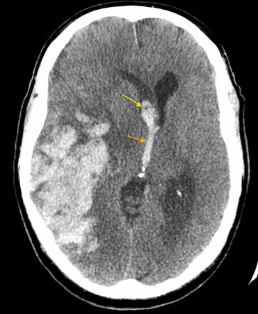 Intracerebral haemorrhage