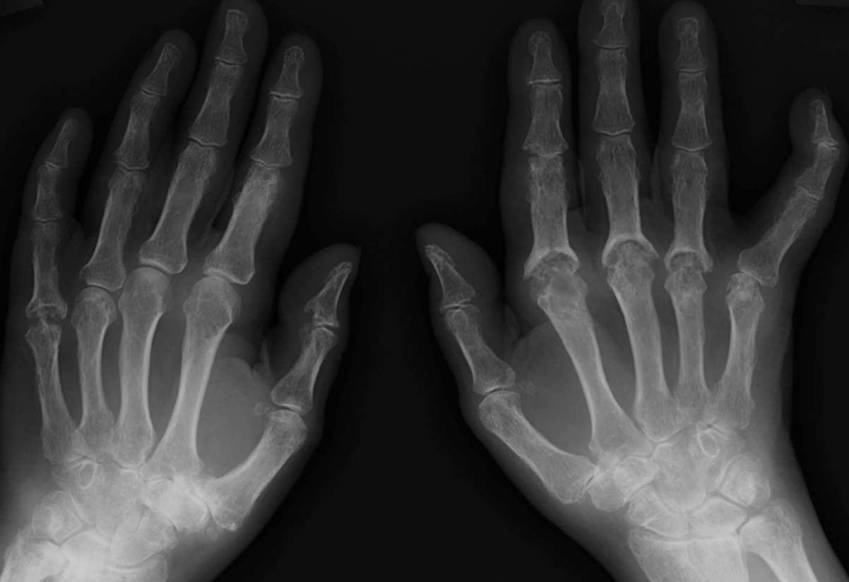 Rheumatoid arthritis radiology stages
