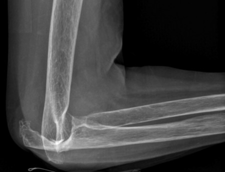 Rheumatoid arthritis – elbow