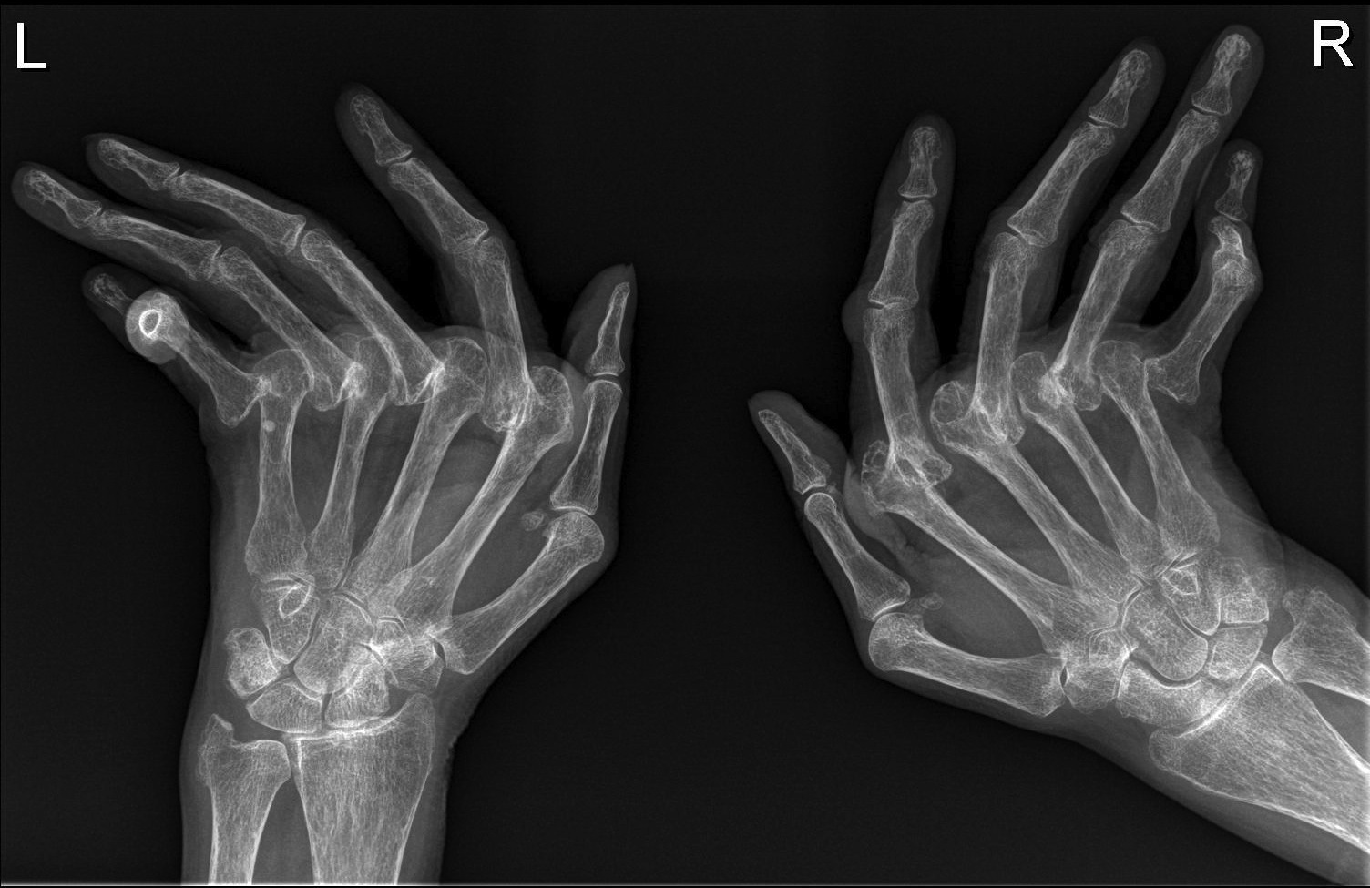 rheumatoid arthritis radiology mri