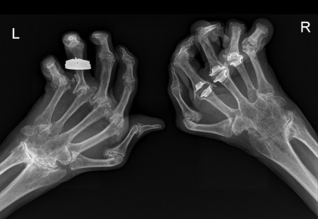 Rheumatoid arthritis – hands