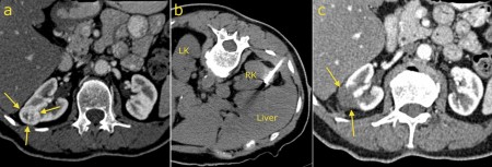 Radiofrequency ablation – RCC