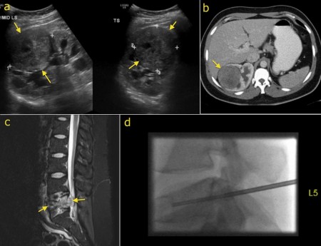 Renal cell carcinoma