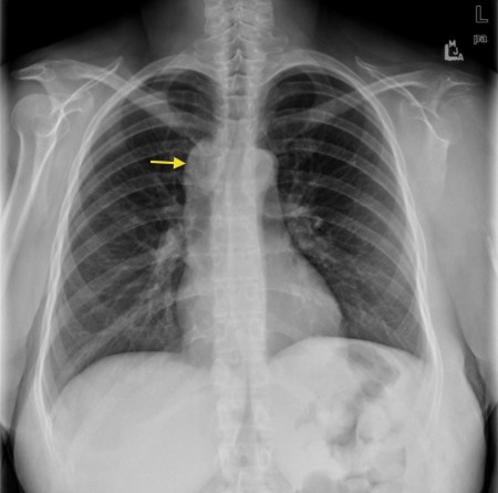 Metastatic lymphadenopathy