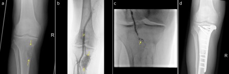 Embolization of renal cell carcinoma metastasis