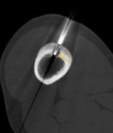 Radiofrequency ablation osteoid osteoma