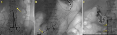 Gastrostomy tube insertion (RIG)