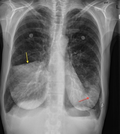 Right middle lobe pneumonia