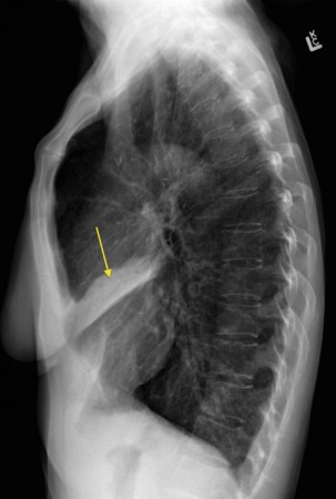 Right middle lobe collapse – lateral CXR