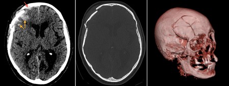 Skull fracture – CT