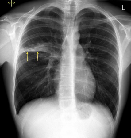 Right upper lobe consolidation – CXR