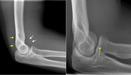 Radial head fracture