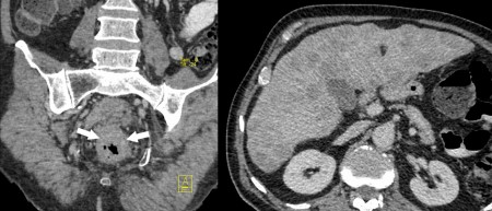 Rectal cancer – CT