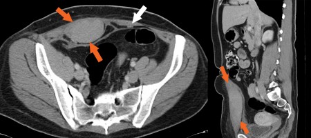 Rectus sheath haematoma – CT