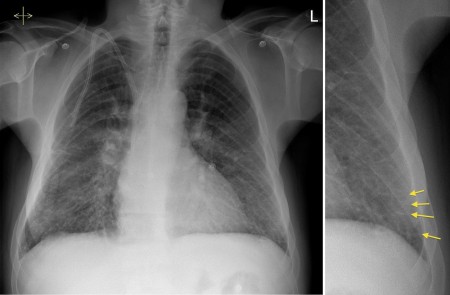 Pulmonary oedema – renal failure
