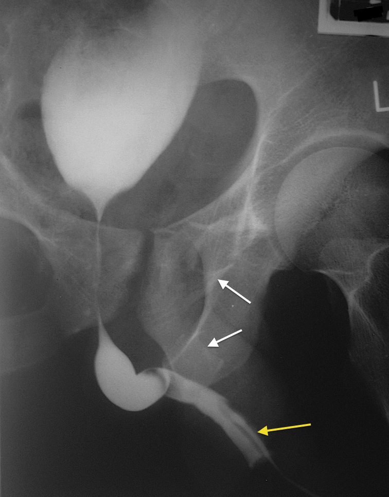 Retrograde urethrogram Radiology at St. Vincent's University Hospital