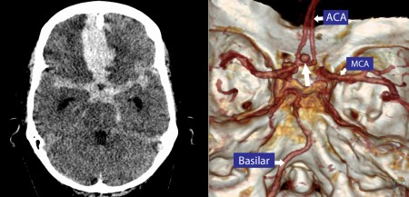 Huge subarachnoid haemorrhage – CT angio