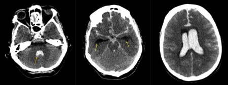 Acute subarachnoid haemorrhage (2)