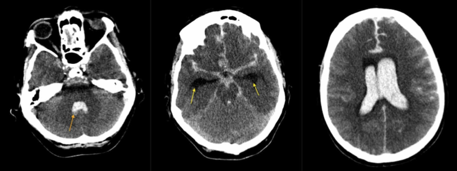 Subarachnoid Hemorrhage (SAH) - Brain, Spinal Cord, and Nerve