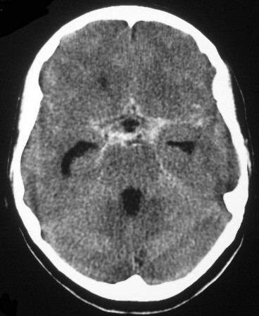 Acute subarachnoid haemorrhage