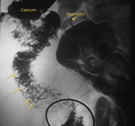 Crohn Disease – Barium Follow Through