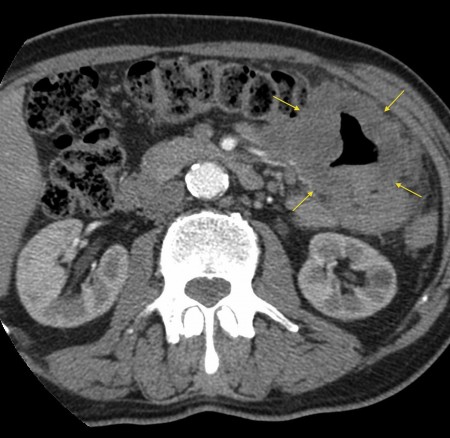 Small bowel lymphoma