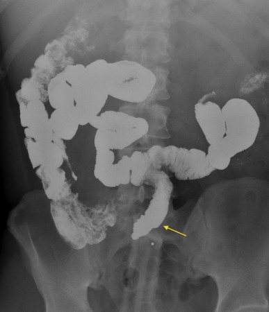 Meckel diverticulum