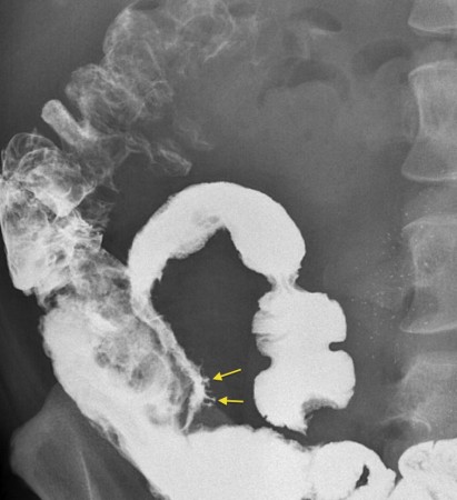 Crohn disease – rosethorn ulcers