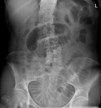 Small bowel obstruction – adhesions