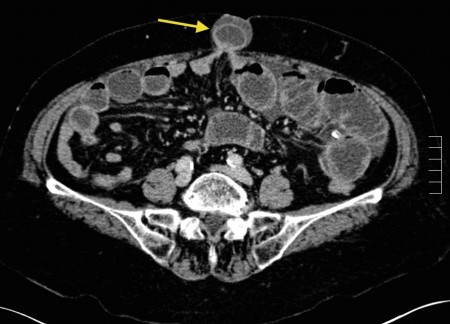 Small bowel obstruction due to hernia