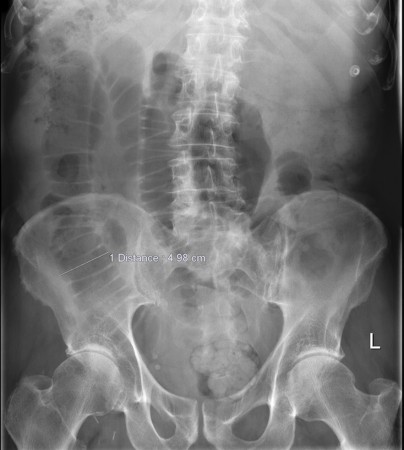 Small bowel obstruction