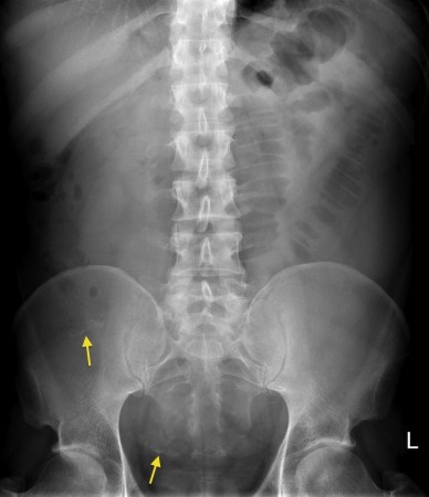 Small bowel obstruction